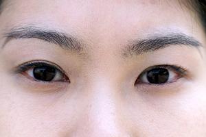 脂肪吸引の最新施術方法とアフターケアについて徹底解説